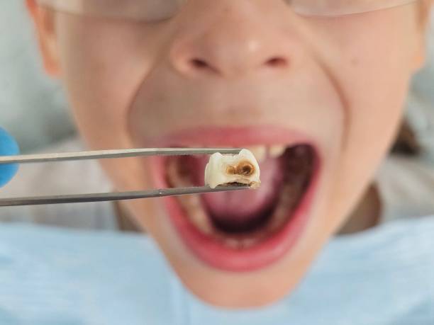 Best Knocked-Out Tooth (Avulsed Tooth) Treatment in East Cleveland, OH